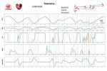 Telemetrie-Analyse nach 6 Runden bei der Alfa Romeo Driving Academy: Der Verbremser in den Daten.